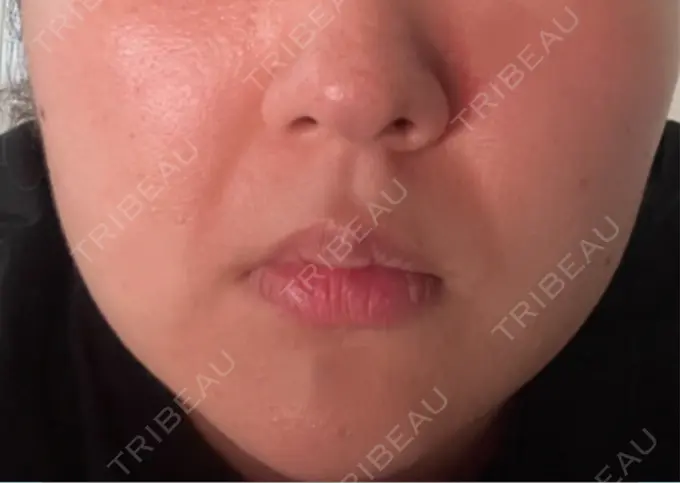 ボトックス（エラ・小顔） 湘南美容クリニック 新百合ヶ丘院 BEFORE メイン用