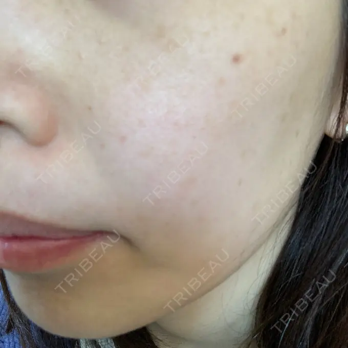 光治療（フォトフェイシャルなど） ルラ美容クリニック 広島院 BEFORE メイン用