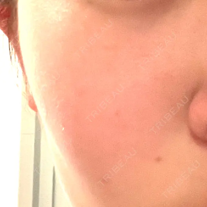 ピコフラクショナルレーザー（毛穴・ニキビ跡） サクラアズクリニック 天神院 BEFORE メイン用