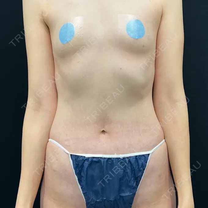 脂肪吸引（脚） / 豊胸（脂肪注入） 湘南美容クリニック 吉祥寺院 BEFORE メイン用