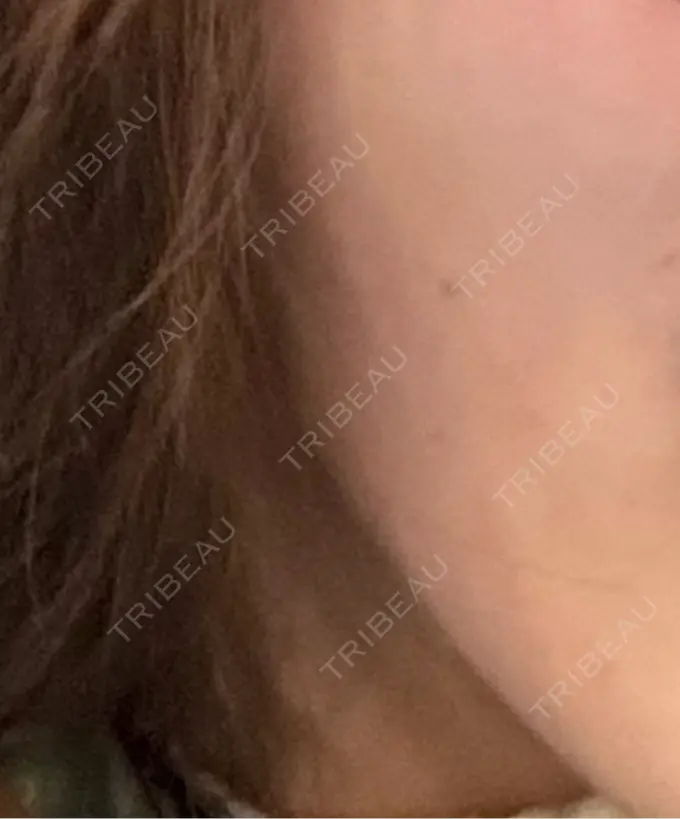 ボトックス（エラ・小顔） / ボトックス（口角） / ボトックス（肩） TCB東京中央美容外科 立川院 BEFORE メイン用