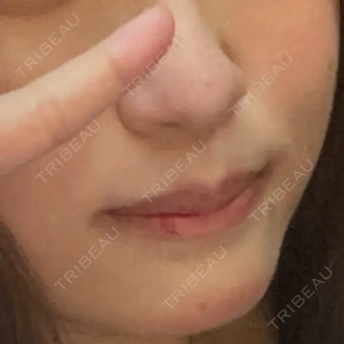 二重埋没 / 糸リフト / バッカルファット除去 / ジョールファット除去 / ボトックス（エラ・小顔） / その他（目元） / その他（輪郭） MEMOTO CLINIC 名古屋 BEFORE メイン用