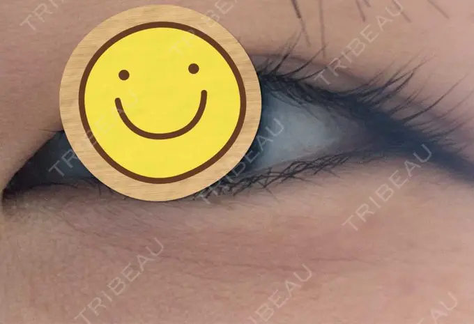 ヒアルロン酸注入（涙袋） / ボトックス（額） ルヴィクリニック イオンドーム前院 BEFORE メイン用