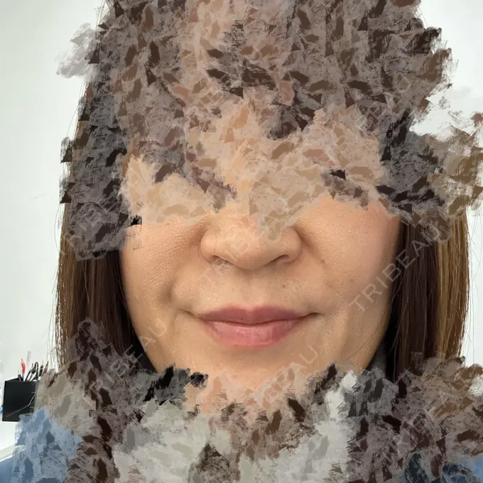 プラセンタ注射 / 美容点滴・美容注射（疲労回復） / その他（口元） TCB東京中央美容外科 久留米院 BEFORE メイン用