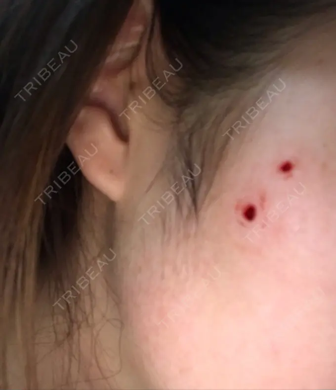 ほくろ・いぼ切除（肌） シンシアガーデンクリニック 太田院 BEFORE メイン用