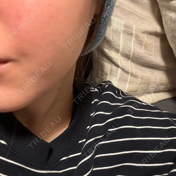 肌育注射（ジュベルックなど） ハナビューティークリニック BEFORE メイン用