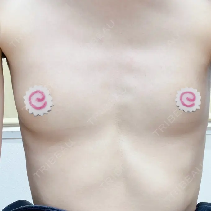 豊胸（シリコンバッグ） ジョウクリニック 那覇院 BEFORE メイン用