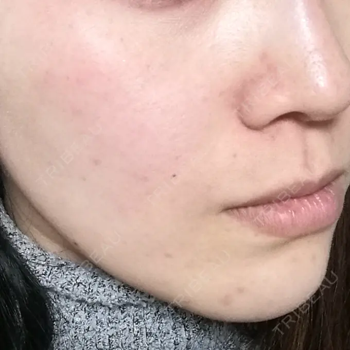 ピコレーザートーニング（美白・肝斑） / ピコフラクショナルレーザー（毛穴・ニキビ跡） DAILY SKIN CLINIC 心斎橋院 BEFORE メイン用