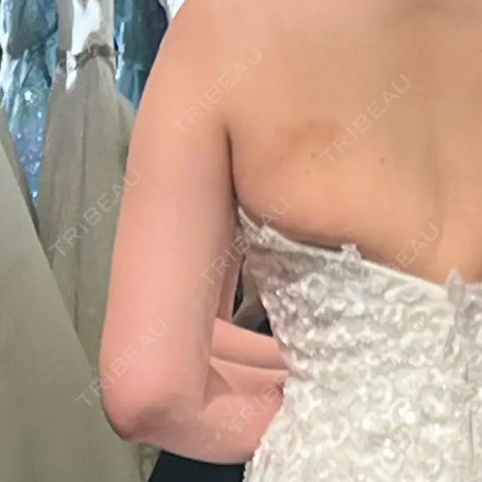 脂肪溶解注射（二の腕） MKクリニック 日本橋院 BEFORE メイン用