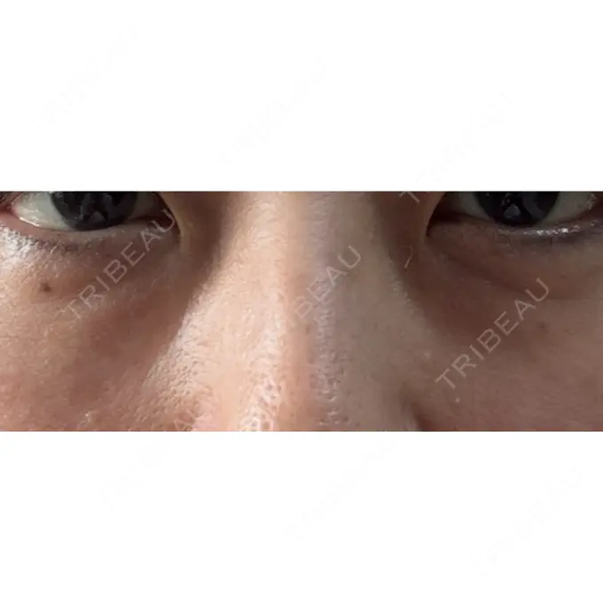 クマ治療 / 美容点滴・美容注射（疲労回復） REVO CLINIC PLUS BEFORE メイン用