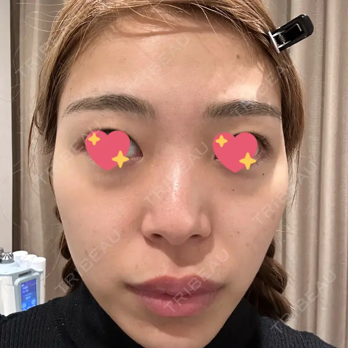 エレクトロポレーション / 毛穴洗浄（ハイドラフェイシャルなど） 心斎橋KT美容クリニック BEFORE メイン用