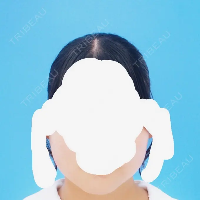 RF（高周波）たるみ治療 RIVER CLINIC（リバークリニック） BEFORE メイン用