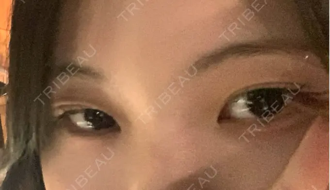 二重埋没 / 自然癒着法 東京シンデレラ美容外科 池袋院 BEFORE メイン用