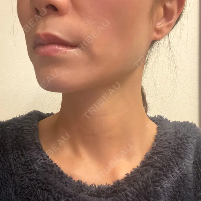 ボトックス（エラ・小顔） / ハイフ（顔） / ピーリング（ハリ・ツヤ） LOUIS CLINIC 二子玉川院【ルイクリニック】 BEFORE メイン用