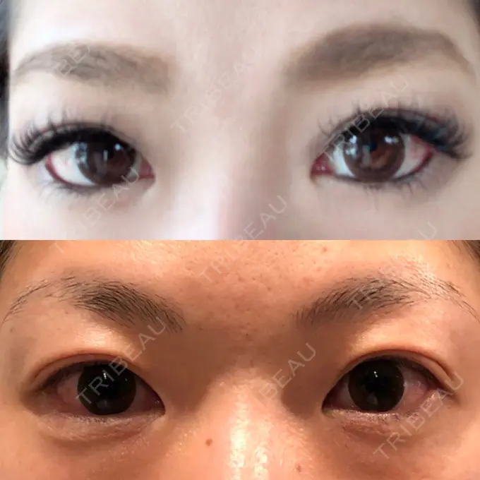 二重埋没 湘南美容クリニック 京都院 BEFORE メイン用