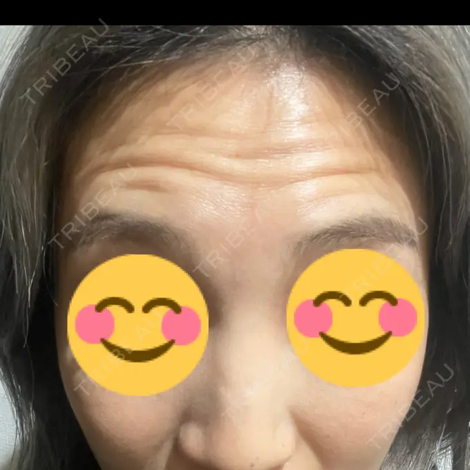 シワ取りボトックス / ボトックス（目尻） / ボトックス（額） 湘南美容クリニック 横浜院 BEFORE メイン用