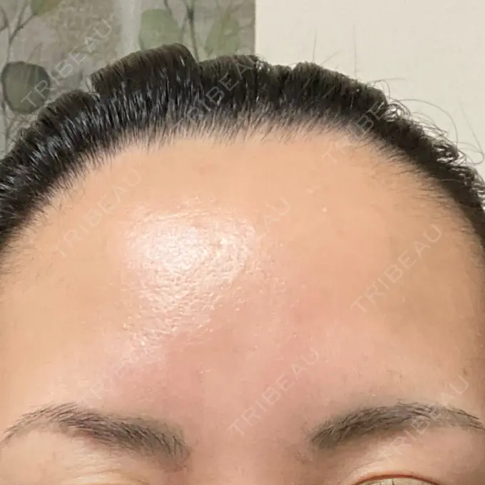 ボトックス（額） TCB東京中央美容外科 神戸院 BEFORE メイン用