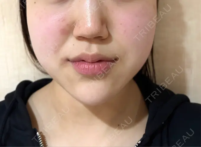 ボトックス（エラ・小顔） / ボトックス（肩） HAAB BEAUTY CLINIC 名古屋院 BEFORE メイン用