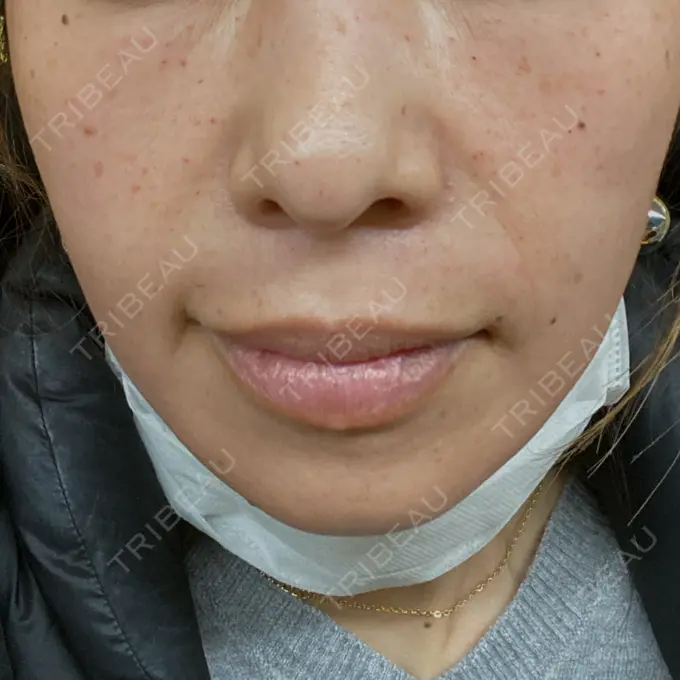 水光注射（ハリ・美肌） 筋肉・美容クリニック BEFORE メイン用