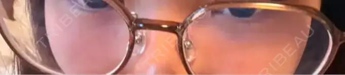 イオン導入 城本クリニック 名古屋院 BEFORE メイン用