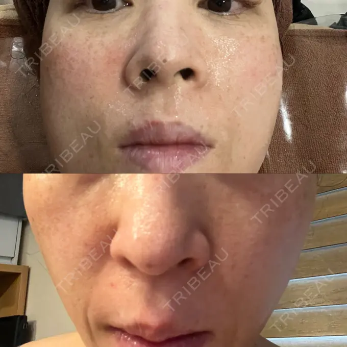 肌ヒアルロン酸注入（たるみ・シワ改善） / ボトックス（目尻） / ピーリング（ハリ・ツヤ） / リジュラン / その他（目元） ドクタープチ美容クリニック -明洞店 BEFORE メイン用