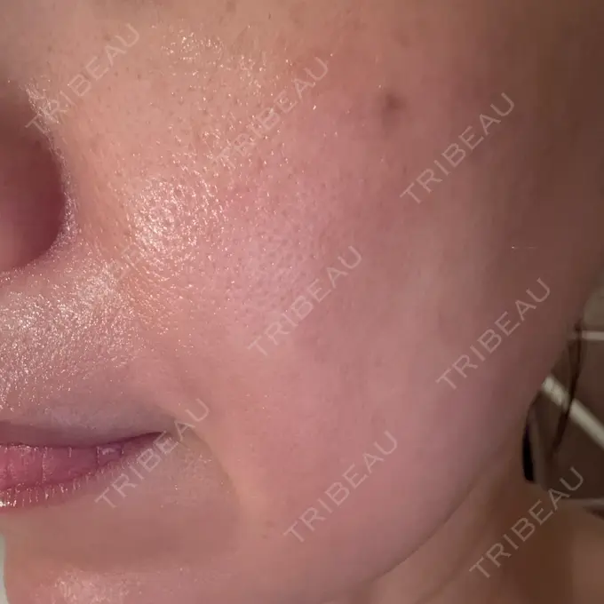 水光注射（ハリ・美肌） 筋肉・美容クリニック BEFORE メイン用