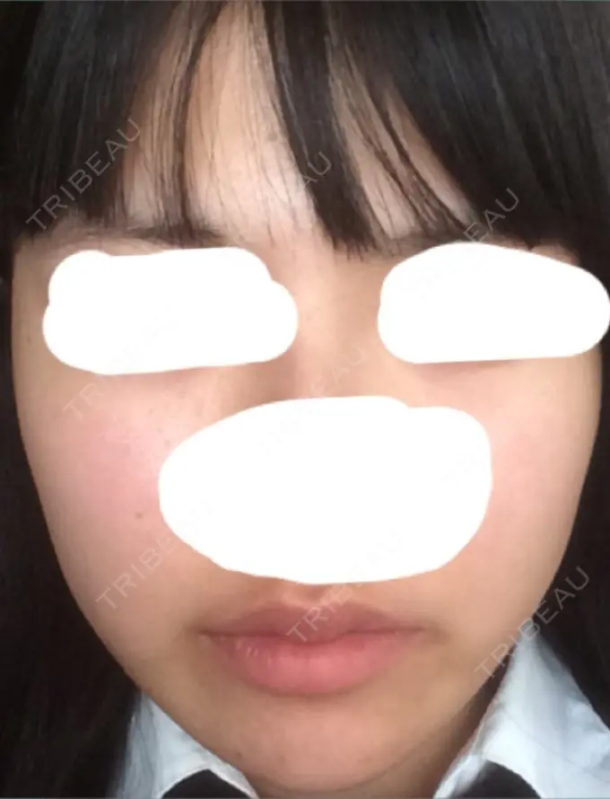 脂肪吸引（顔） T.O.P整形外科 BEFORE メイン用