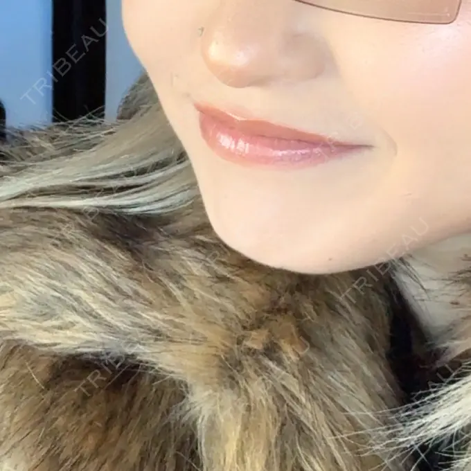 ボトックス（あご） / ヒアルロン酸注入（唇） / ボトックス（口角） eクリニック 那覇院 BEFORE メイン用