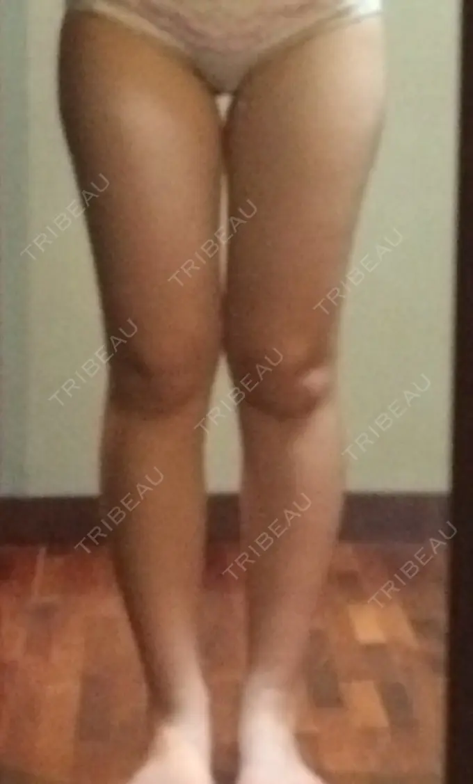 脂肪吸引（脚） T.O.P整形外科 BEFORE メイン用