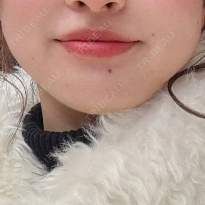 脂肪吸引注射（顔） / ボトックス（エラ・小顔） / RF（高周波）たるみ治療 Wing clinic 豊中駅前院 BEFORE メイン用