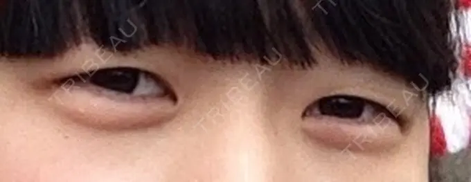 二重埋没 品川スキンクリニック広島院 BEFORE メイン用