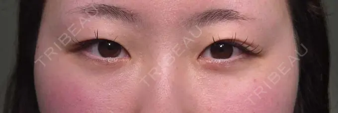 二重埋没 HAAB×DREAM BEAUTY CLINIC 大阪梅田院 BEFORE メイン用