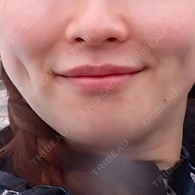 糸リフト / 脂肪吸引（顔） / 脂肪吸引注射（顔） / ヒアルロン酸注入（頬） ziz CLINIC BEFORE メイン用