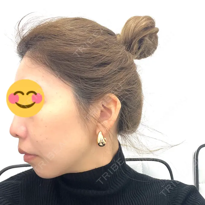 ボトックス（あご） / ヒアルロン酸注入（あご） TCB東京中央美容外科 仙台駅前院 BEFORE メイン用