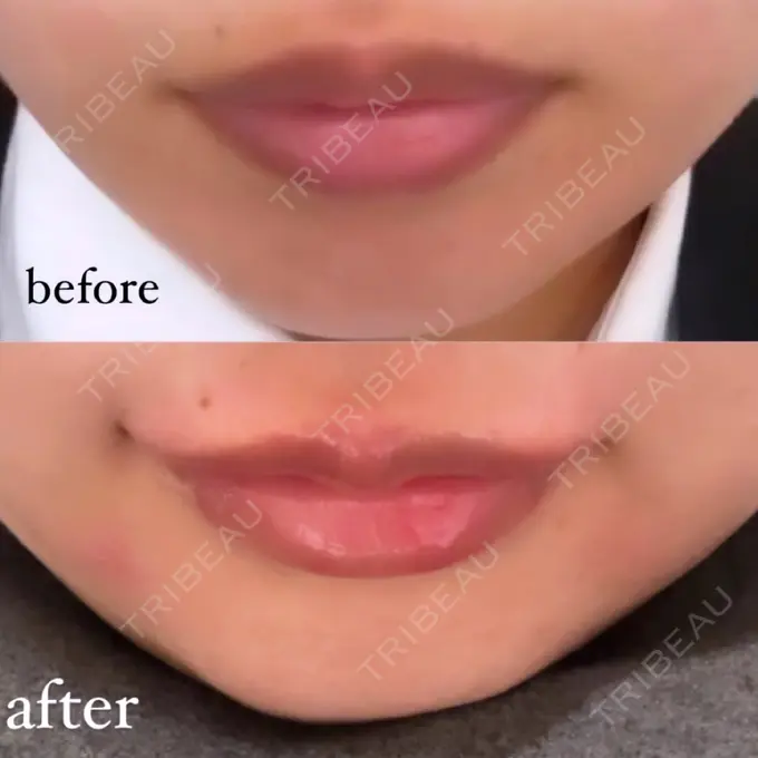 ヒアルロン酸注入（唇） / ボトックス（口角） 銀座美容外科クリニック 銀座院 BEFORE メイン用