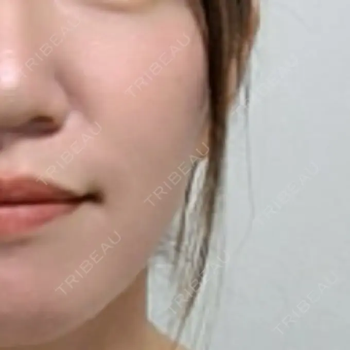 ボトックス（エラ・小顔） / その他（鼻） ルラ美容クリニック 渋谷本院 BEFORE メイン用