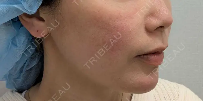 糸リフト 形成外科と美容外科のクリニック池袋 BEFORE メイン用