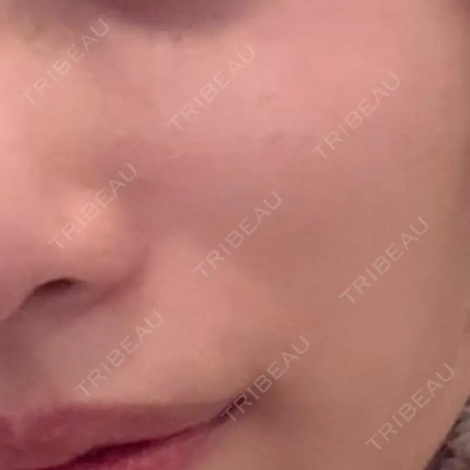 医療脱毛（顔） / 医療脱毛（ワキ） おおかみ美容のクリニック 横浜院 BEFORE メイン用