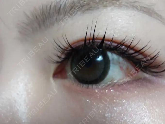 ヒアルロン酸注入（涙袋） パルム美容クリニック BEFORE メイン用