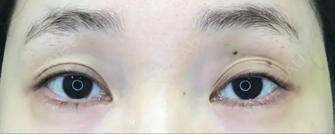 二重埋没 / 糸リフト / 脂肪吸引（顔） / ボトックス（あご） / ヒアルロン酸注入（あご） TCB東京中央美容外科 新宿東口院 BEFORE メイン用