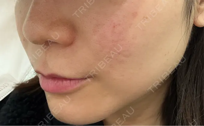 サブシジョン コスメディカルクリニック シンシア 渋谷院 BEFORE メイン用