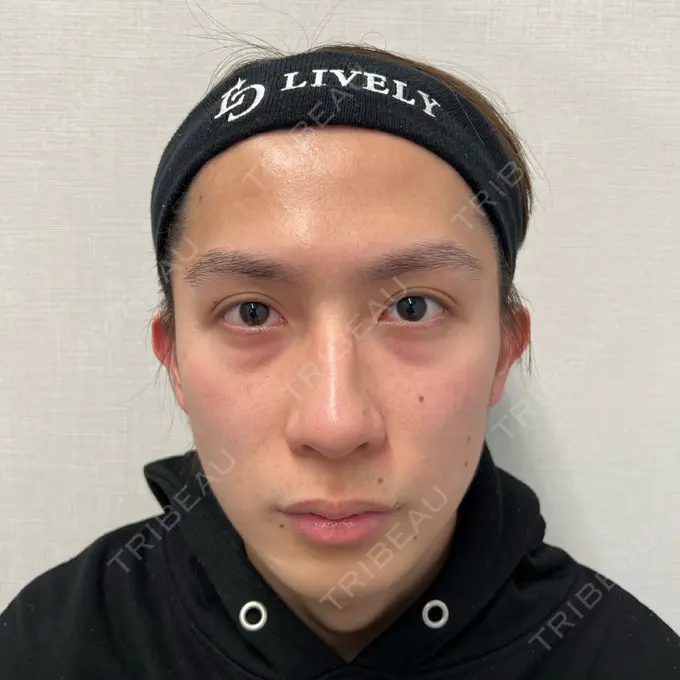 クマ治療 ライブリークリニック 船橋院 BEFORE メイン用