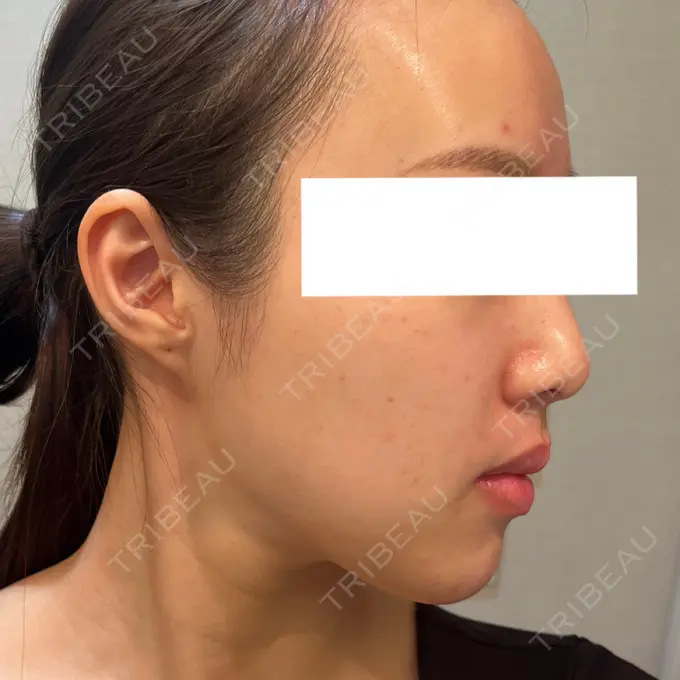 ピコレーザートーニング（美白・肝斑） Designo Clinic （デジーノクリニック） BEFORE メイン用