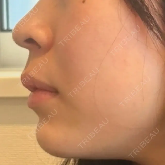 RF（高周波）たるみ治療 RIVER CLINIC（リバークリニック） BEFORE メイン用