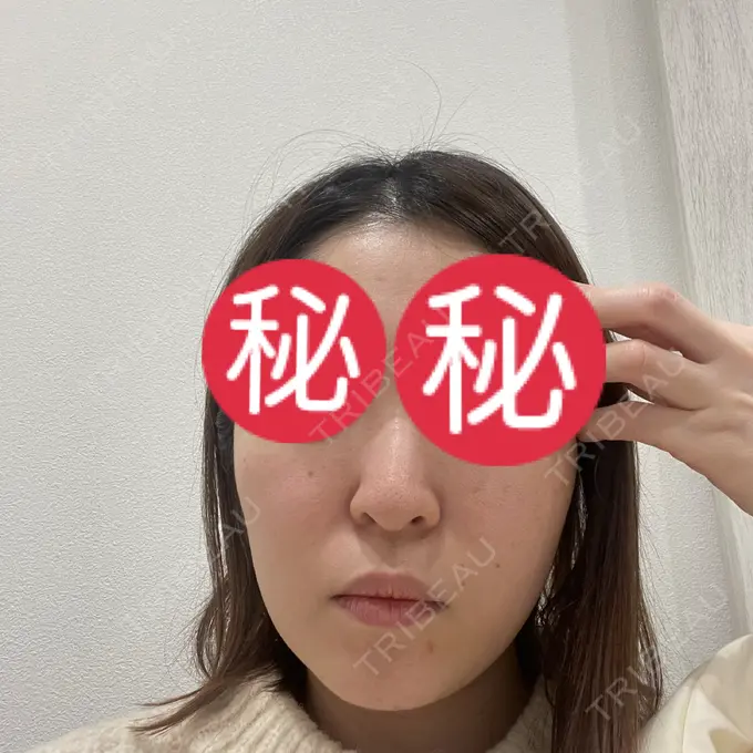 ピーリング（ハリ・ツヤ） ミニマムスキンクリニック池袋 BEFORE メイン用