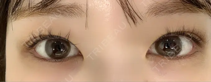 ヒアルロン酸注入（涙袋） / ヒアルロン酸注入（唇） / ボトックス（口角） ルラ美容クリニック 渋谷本院 BEFORE メイン用