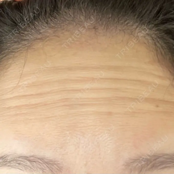 シワ取りボトックス / ボトックス（眉間） / ボトックス（額） / その他（鼻） カジュアルクリニック 平塚院 BEFORE メイン用