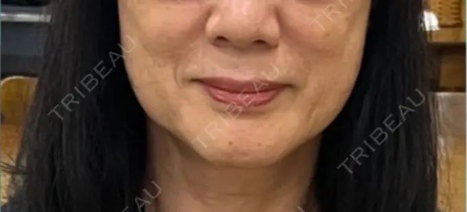 糸リフト MAクリニック 心斎橋 BEFORE メイン用