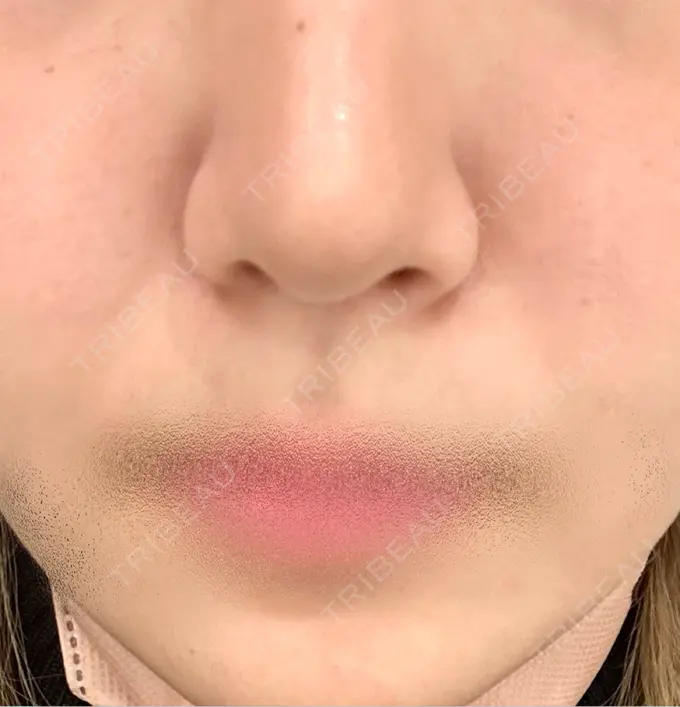 その他（口元） フィラークリニック 新宿院 BEFORE メイン用