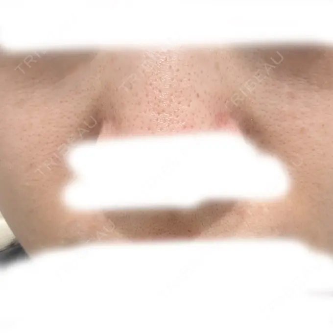 水光注射（ハリ・美肌） / 肌育注射（ジュベルックなど） / 毛穴洗浄（ハイドラフェイシャルなど） オラクル美容皮膚科 名古屋院 BEFORE メイン用